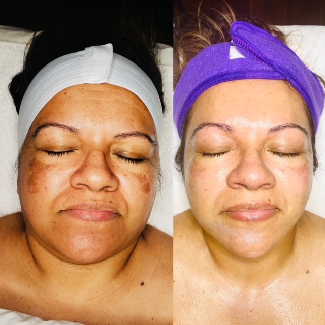 Two pictures side by side, left photo is the before woman's face is swollen and darker complexion, wrinkles on forehead, sun damage on cheeks. Right picture same woman after brighter complexion, contoured skin, 80% reduction of sun damage, no wrinkles and higher cheek bones.