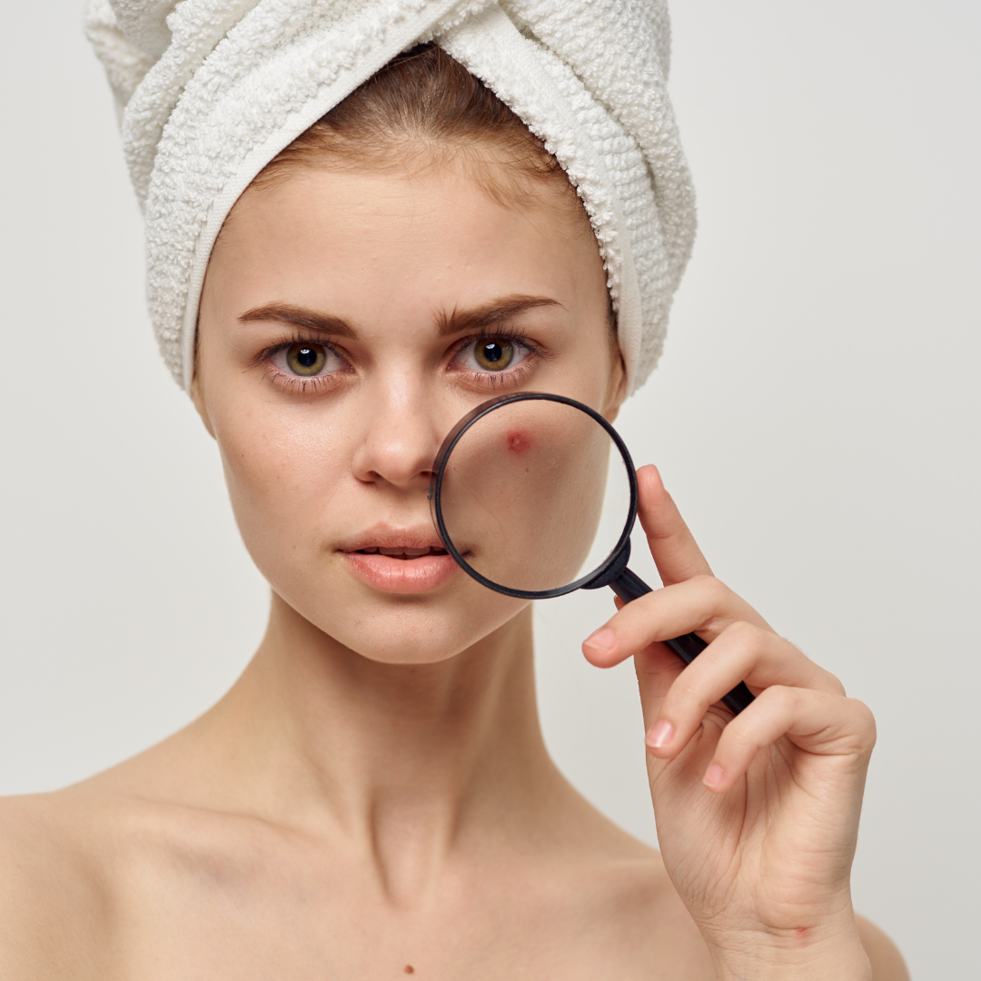 Understanding Acne: Types, Causes, and Treatments